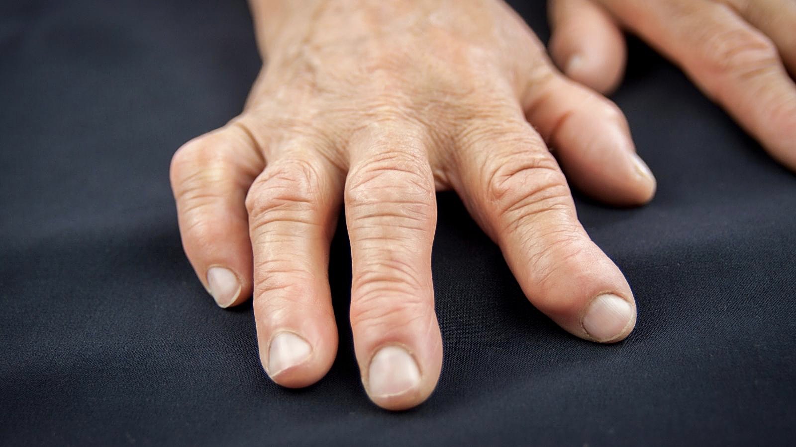 A reumatoid arthritis tünetei, hajlamosító tényezői és kezelése - UD youMED
